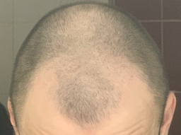 Лосьон против выпадения волос Folixidil Minoxidil medical 5% 50 мл (8032706442817) фото от покупателей 11