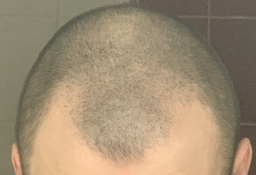 Лосьон против выпадения волос Folixidil Minoxidil medical 5% 50 мл (8032706442817) фото от покупателей 10