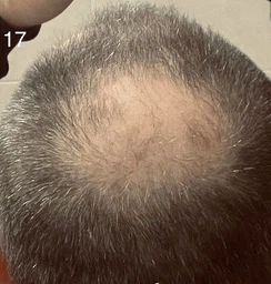 5% Minoxidil Kirkland для росту волосся та бороди (3 флакона + дозатор) фото від покупців 19