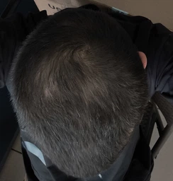 Лосьон против выпадения волос Folixidil Minoxidil medical 5% 50 мл (8032706442817) фото от покупателей 2