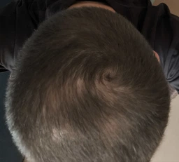 Лосьон против выпадения волос Folixidil Minoxidil medical 5% 50 мл (8032706442817) фото от покупателей 1