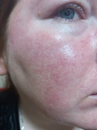 Увлажняющий тонер SKIN1004 Madagascar Centella Toning Toner с азиатской центеллой 30 мл (8809576261196) фото от покупателей 1