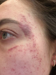 Пигментный Отбеливающий Крем с Гидрохиноном 4% 30 грамм | Abbott Hydroquinone Cream USP Melalite Forte | Expigment | Мелалит фото от покупателей 2