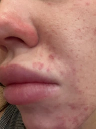 Пигментный Отбеливающий Крем с Гидрохиноном 4% 30 грамм | Abbott Hydroquinone Cream USP Melalite Forte | Expigment | Мелалит
