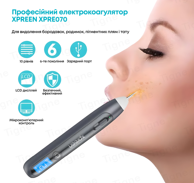 Коагулятор плазменный XPREEN прибор для удаления папиллом и бородавок ...