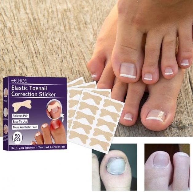 Набір еластичних пластирів Elastic Toenail Correction Sticker для безболісного виправлення врослих нігтів (50 шт.) - изображение 1