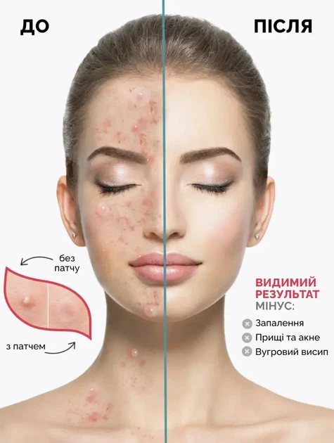 Патчи Reclaire от прыщей и акне 72 шт (2000962946123) - изображение 3