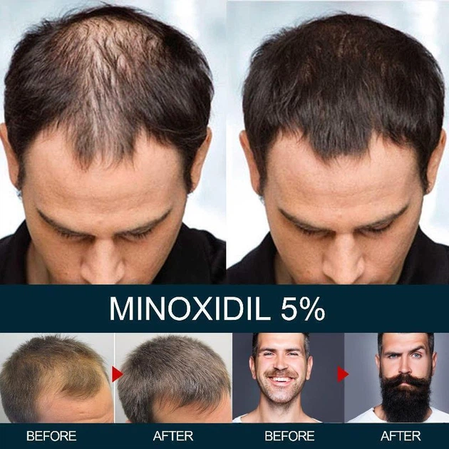 Миноксидил 5% Minoxidil KIRKLAND для роста волос и бороды (2 флакона + оригинальный дозатор) - изображение 2