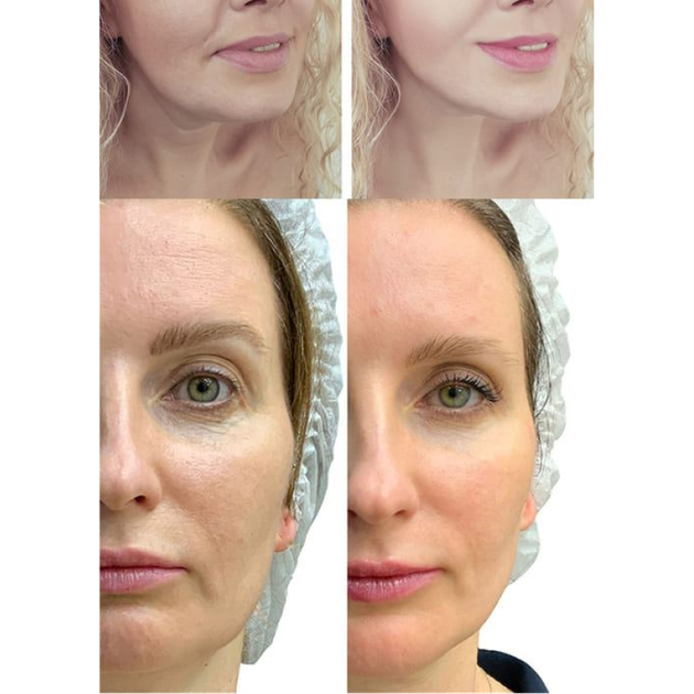 Мікрострумовий RF Lifting Масажер для обличчя Skin Lifting 7.0 Pink - EMS, LED - зображення 13