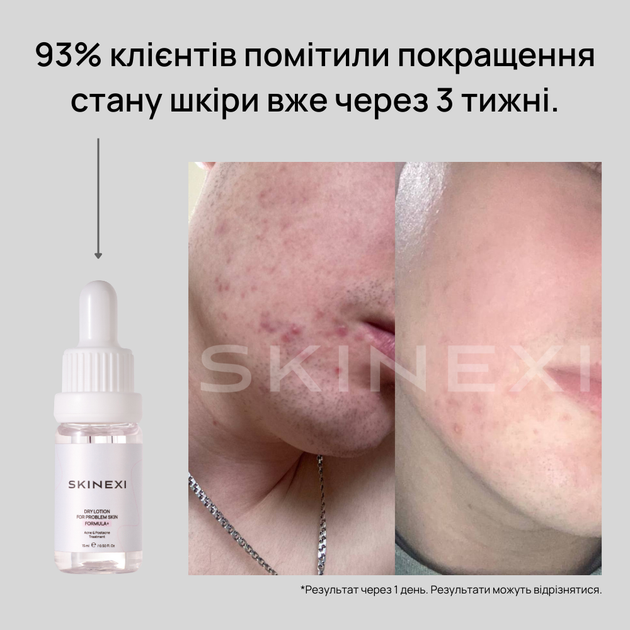 Лосьон для проблемной кожи от прыщей и акне Skinexi Dry Lotion Formula+ 15 мл - Фото 5 Лосьон для проблемной кожи от прыщей и акне Skinexi Dry Lotion Formula+ 15 мл - изображение 5