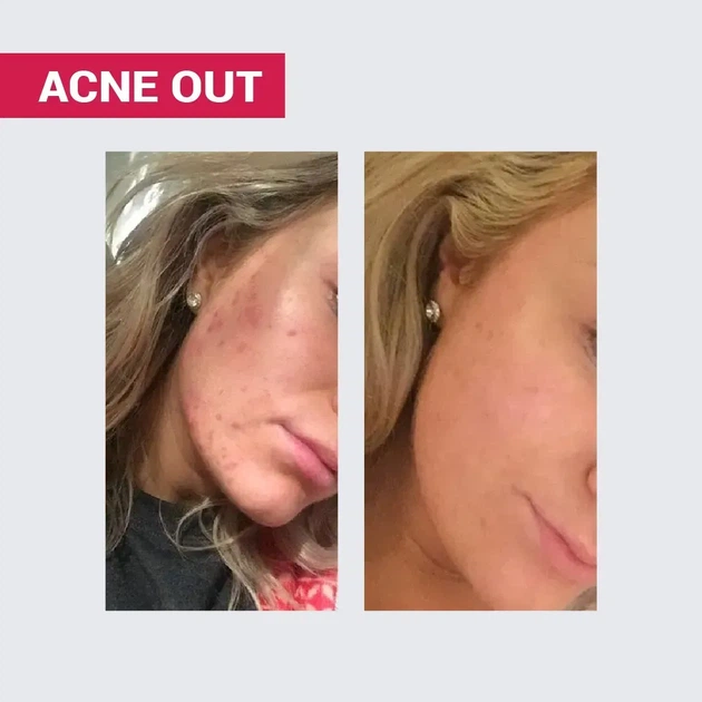 Biotrade (Біотрейд) Acne Out Oxy Wash Cleansing Gel – ніжний гель для вмивання з киснем та молочною кислотою, для жирної та проблемної шкіри обличчя, 200 мл - изображение 3