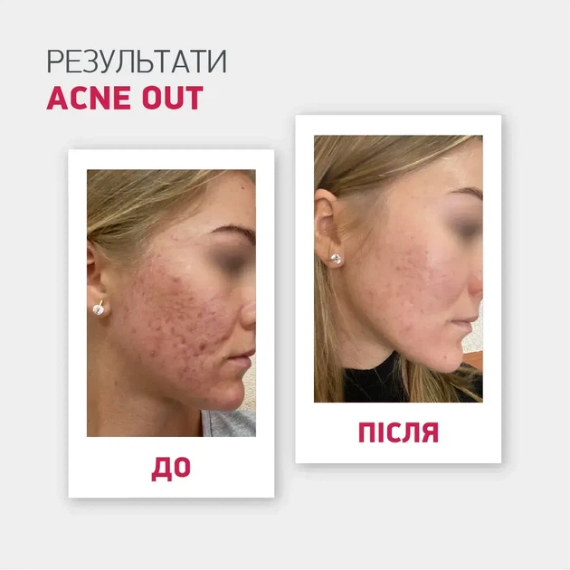Biotrade (Біотрейд) Acne Out SPF30 – відновлювальний крем для обличчя зі шкірою з видимими дефектами та плямами постакне, 30 мл - Фото 2 Biotrade (Біотрейд) Acne Out SPF30 – відновлювальний крем для обличчя зі шкірою з видимими дефектами та плямами постакне, 30 мл - изображение 2