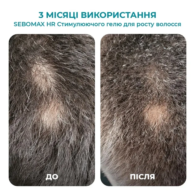 Biotrade (Біотрейд) Sebomax HR Anti-Hair Loss Gel – стимулювальний гель проти випадіння волосся, 26 мл - зображення 2