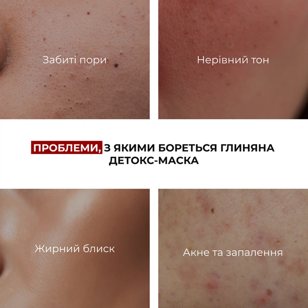 Глиняна маска для обличчя Hillary Anti-Acne детокс для проблемної шкіри очищення акне 90 мл (652933) - зображення 5