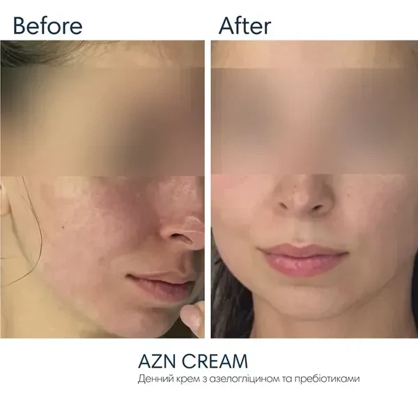 Солнцезащитный противовоспалительный крем SPF30 BRADERM AZN Cream, 30 мл 00-00000387 - Фото 3 Солнцезащитный противовоспалительный крем SPF30 BRADERM AZN Cream, 30 мл 00-00000387 - изображение 3