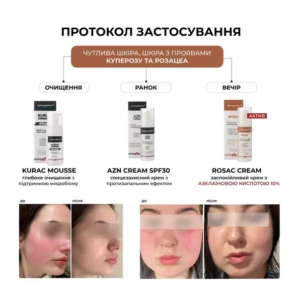 Успокаивающий крем BRADERM Rosac Cream, 30 мл 00-00000389 - Фото 2 Успокаивающий крем BRADERM Rosac Cream, 30 мл 00-00000389 - изображение 2