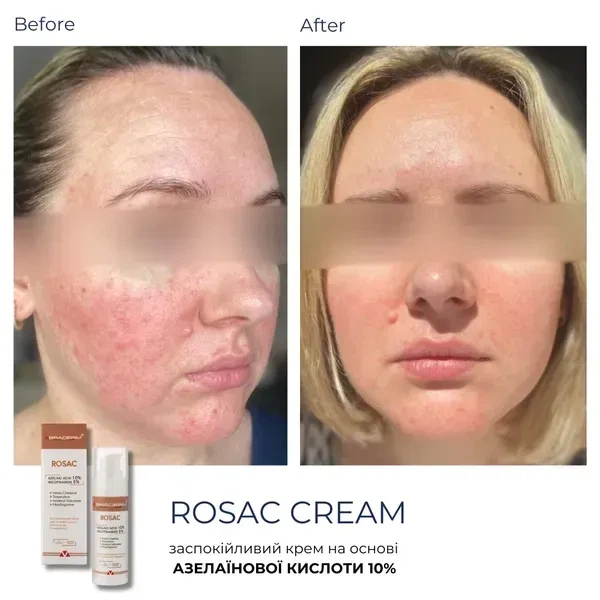Успокаивающий крем BRADERM Rosac Cream, 30 мл 00-00000389 - Фото 4 Успокаивающий крем BRADERM Rosac Cream, 30 мл 00-00000389 - изображение 4