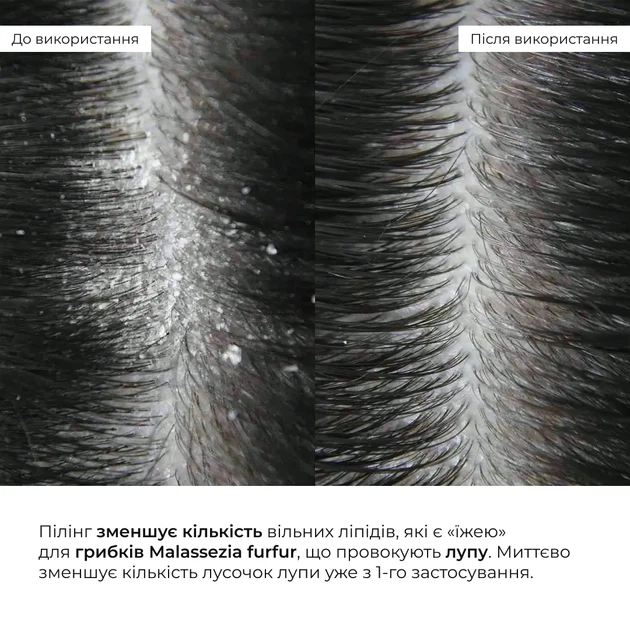 Энзимный пилинг для кожи головы Hillary Trichological Scalp Peel 120 мл безсульфатный - Фото 18 Энзимный пилинг для кожи головы Hillary Trichological Scalp Peel 120 мл безсульфатный - изображение 18