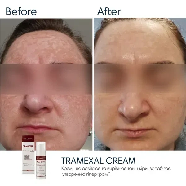 Освітлювальний крем BRADERM Tramexal Cream, 30 мл 00-00000388 - зображення 4