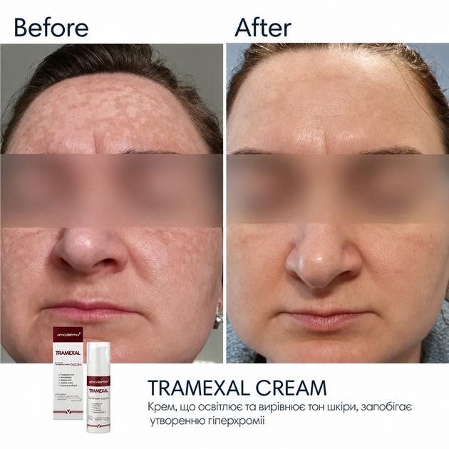 Осветляющий крем BRADERM Tramexal Cream, 30 мл 00-00000388 - изображение 4