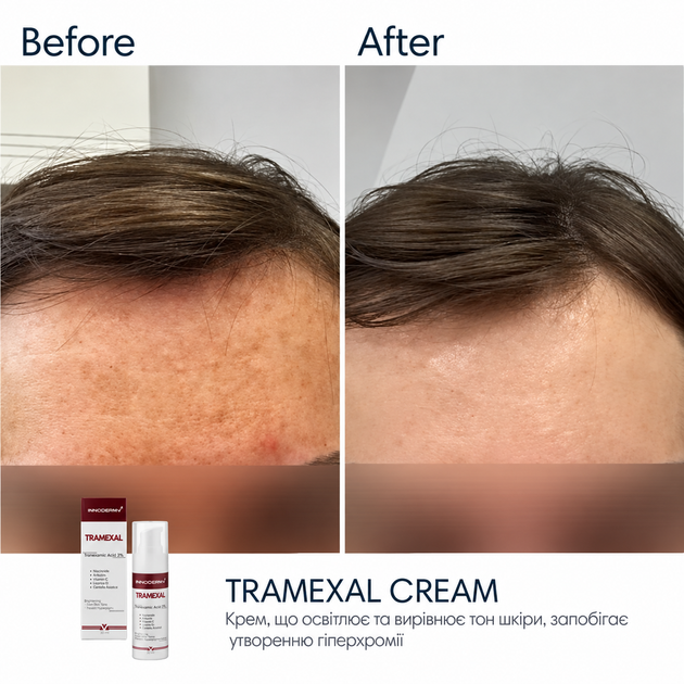 Осветляющий крем BRADERM Tramexal Cream, 30 мл 00-00000388 - изображение 5