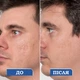Чоловічий силіконовий гель від рубців і шрамів Particle Silicone Scar Gel (30 мл) Made in Israel - зображення 7
