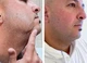 Чоловічий силіконовий гель від рубців і шрамів Particle Silicone Scar Gel (30 мл) Made in Israel - зображення 10