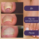 Набір пластирів Elastic Toenail Correction Sticker (50 pcs) для корекції нігтів, що вростають (ECS1000) - зображення 4