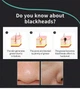 Маска для лица от черных точек LANBENA Blackhead Remover Mask 50 г - изображение 5