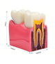 Макет зуба із стоматологічними захворюваннями - зображення 4