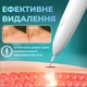 Электрокоагулятор для удаления папиллом и бородавок YP03 Белая + блок питания и иглы в Подарок (00-0000720) - изображение 2