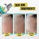 Сыворотка быстрого действия от прыщей Kiehl's Truly Targeted Acne-Clearing Solution Liquid Patch with Salicylic Acid 4 ml Mini - изображение 3