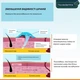 Набор от шрамов Nuvadermis Scar Care Bundle гель и пластырь - изображение 6
