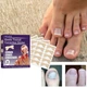 Набор для коррекции врастающих ногтей Elastic Toenail Correction Sticker 50 шт Бежевый (2104618421) - изображение 6