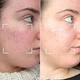 Светодиодная маска CurrentBody Skin Anti-Imperfections LED Face Mask: Series 2 против несовершенств кожи - изображение 6