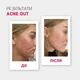Biotrade (Біотрейд) Acne Out SPF30 – відновлювальний крем для обличчя зі шкірою з видимими дефектами та плямами постакне, 30 мл - изображение 2
