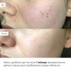 Глиняна маска для обличчя Hillary Anti-Acne детокс для проблемної шкіри очищення акне 90 мл (652933) - зображення 2