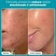 Щоденний ексфоліант Paula’s Choice 2% BHA liquid exfoliant 118 мл - изображение 4