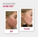 Biotrade (Біотрейд) Acne Out SPF30 – відновлювальний крем для обличчя зі шкірою з видимими дефектами та плямами постакне, 30 мл - изображение 2