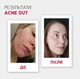 Biotrade (Біотрейд) Acne Out SPF30 – відновлювальний крем для обличчя зі шкірою з видимими дефектами та плямами постакне, 30 мл - изображение 3