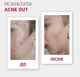 Лосьйон активний Biotrade Acne Out — для проблемної шкіри з запальними формами акне, 60 мл - зображення 2