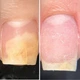 RESULTUM Onistopix Oil Олія від оніхолізису та грибка, 8 мл - изображение 8