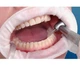OptraGate 2 роторозширювач Regular (R) Ivoclar (Regular 1шт) (1710-2247) - зображення 2