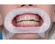 OptraGate 2 Small (S) Ivoclar роторозширювач (Small 1шт) (5010-1424) - зображення 2