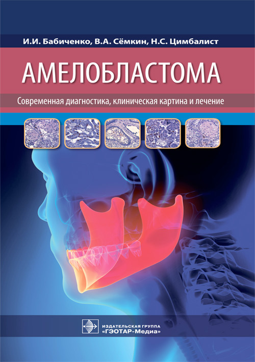 

Амелобластома. Современная диагностика, клиническая картина и лечение