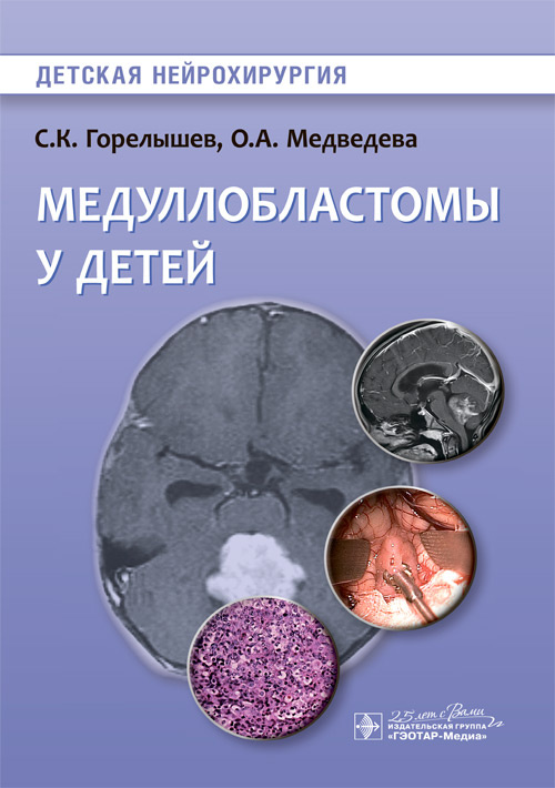 

Медуллобластомы у детей