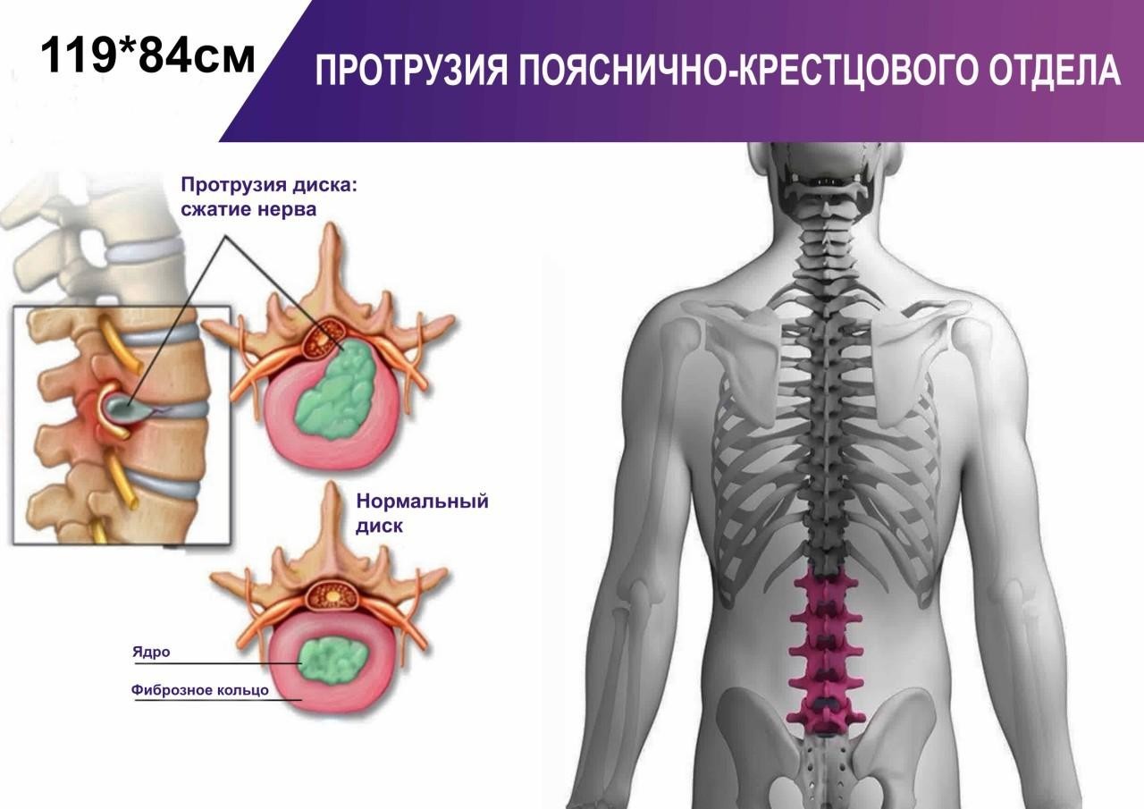 

Плакат Beauty Special Протрузия пояснично-крестцового отдела А0 (4684)
