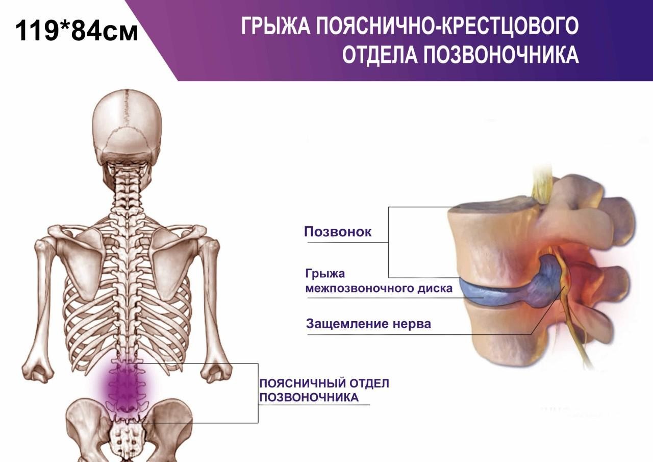 

Плакат Beauty Special Грыжа пояснично-крестцового отдела позвоночника А0 (4689)