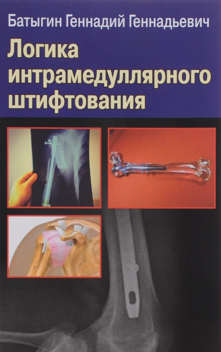 

Логика интрамедуллярного штифтования