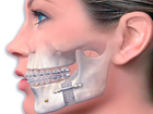 Повязка на голову имобилизационная при травме переломе вывихе челюсти - изображение 5